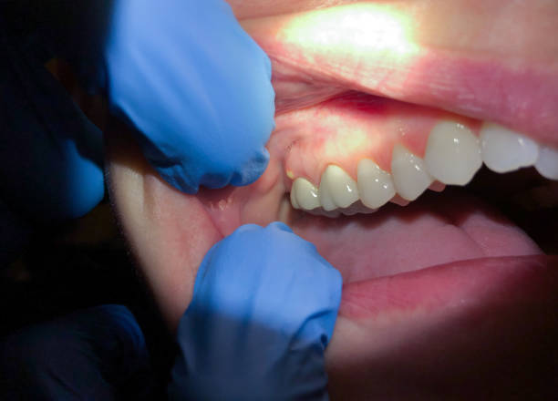 Best Emergency Dental Extractions in Pottsgrove, PA